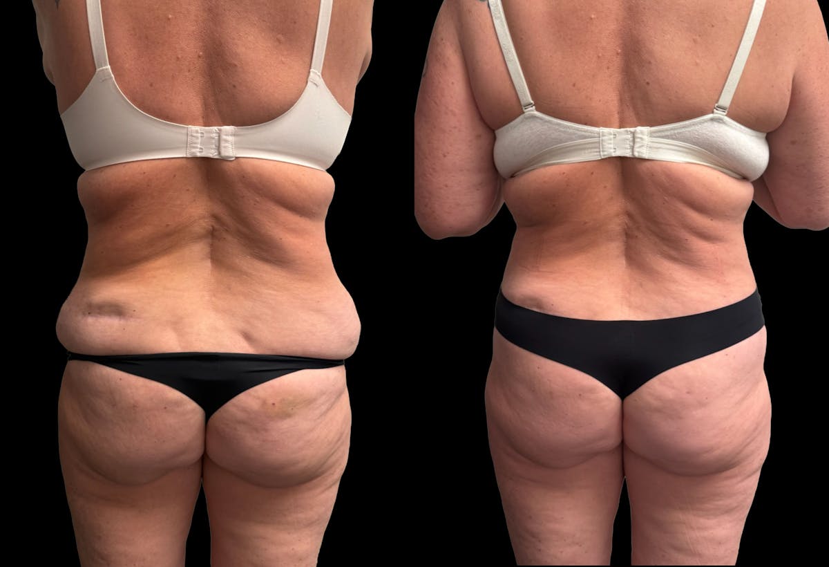Tummy Tuck Before & After Gallery - Patient 342522 - Image 5