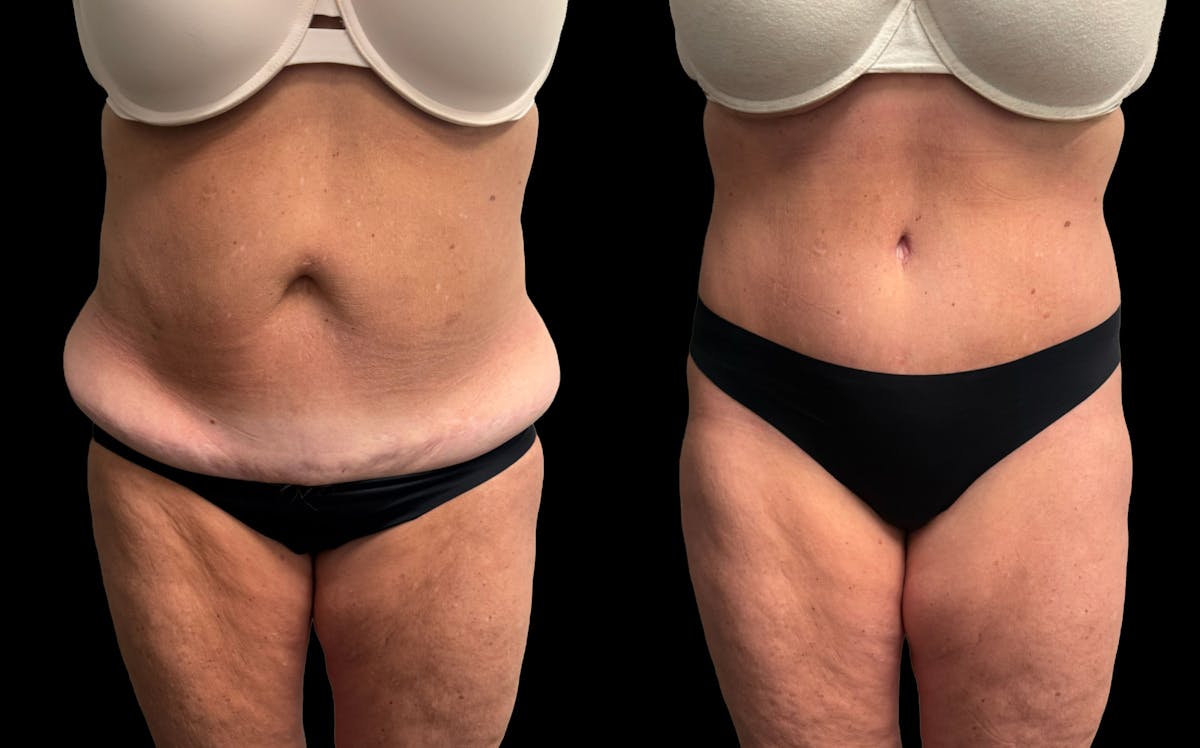 Tummy Tuck Before & After Gallery - Patient 342522 - Image 2
