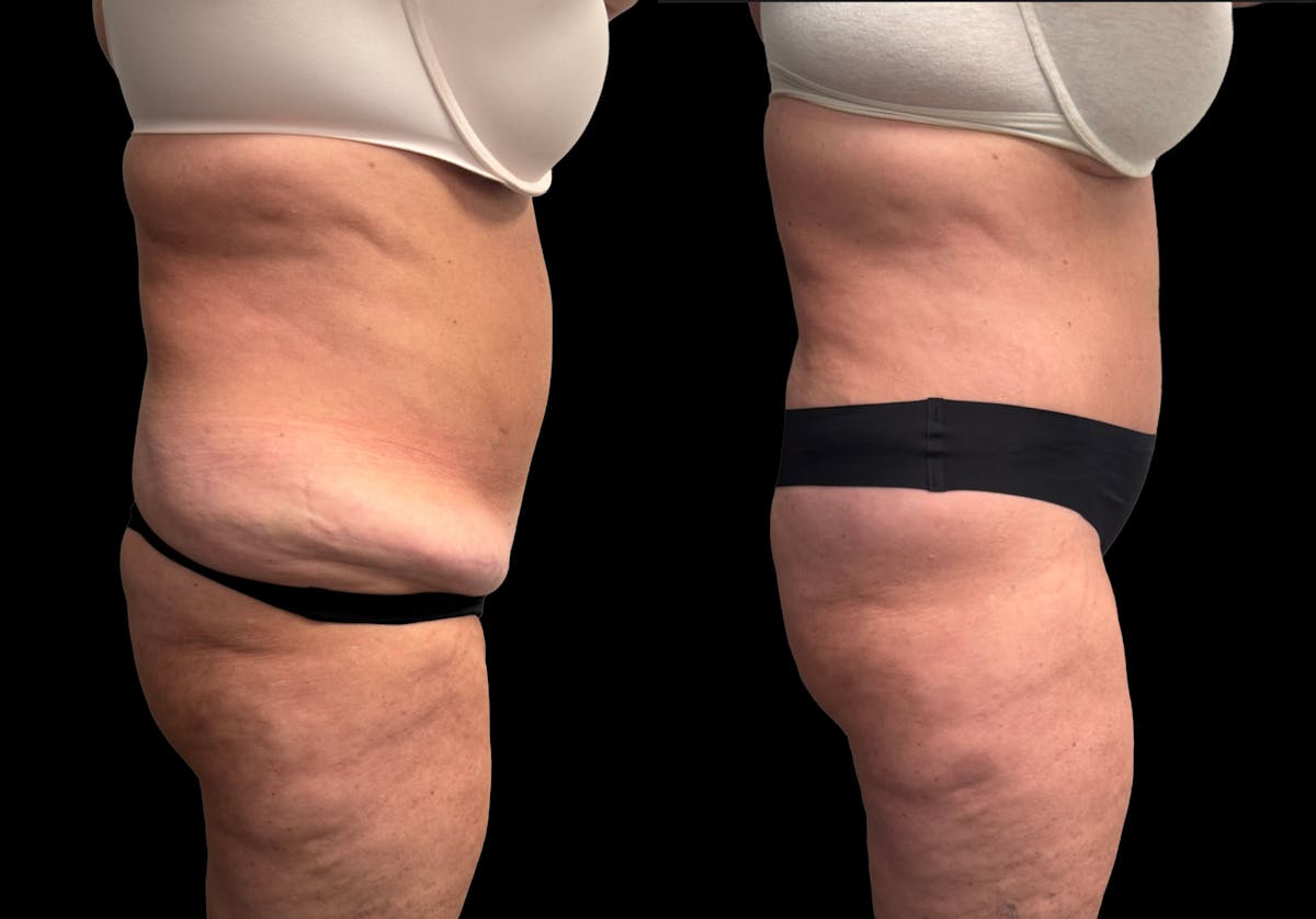 Tummy Tuck Before & After Gallery - Patient 342522 - Image 6