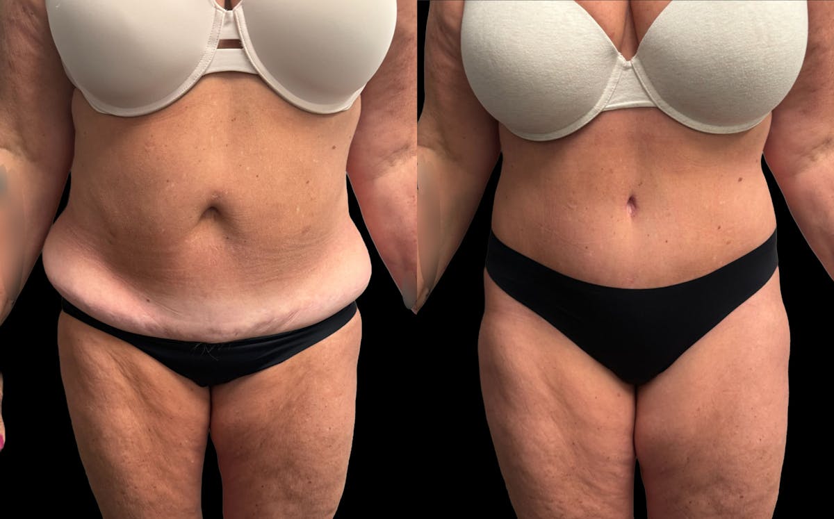Tummy Tuck Before & After Gallery - Patient 342522 - Image 1