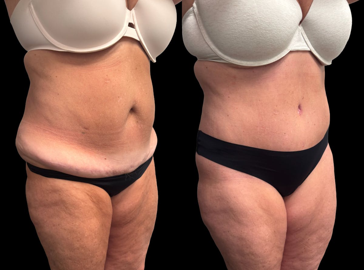 Tummy Tuck Before & After Gallery - Patient 342522 - Image 7