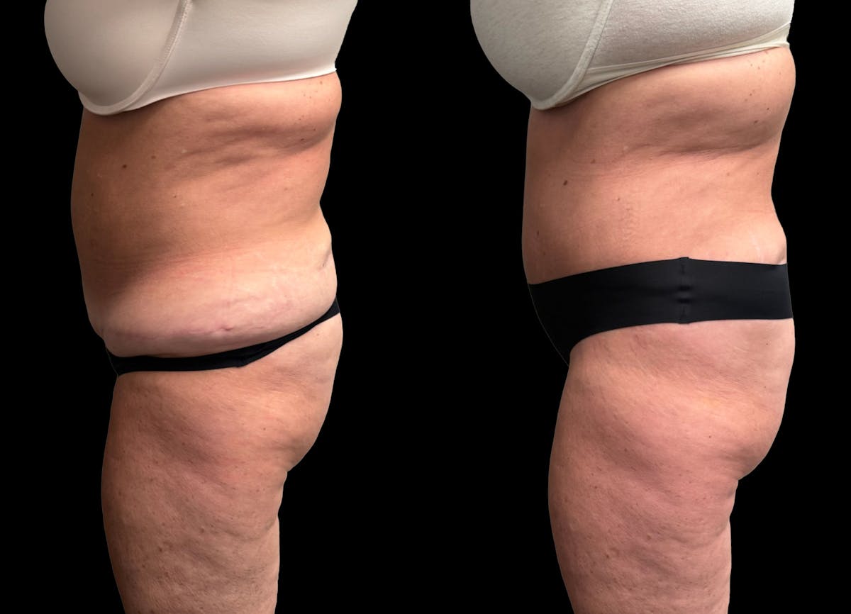 Tummy Tuck Before & After Gallery - Patient 342522 - Image 4