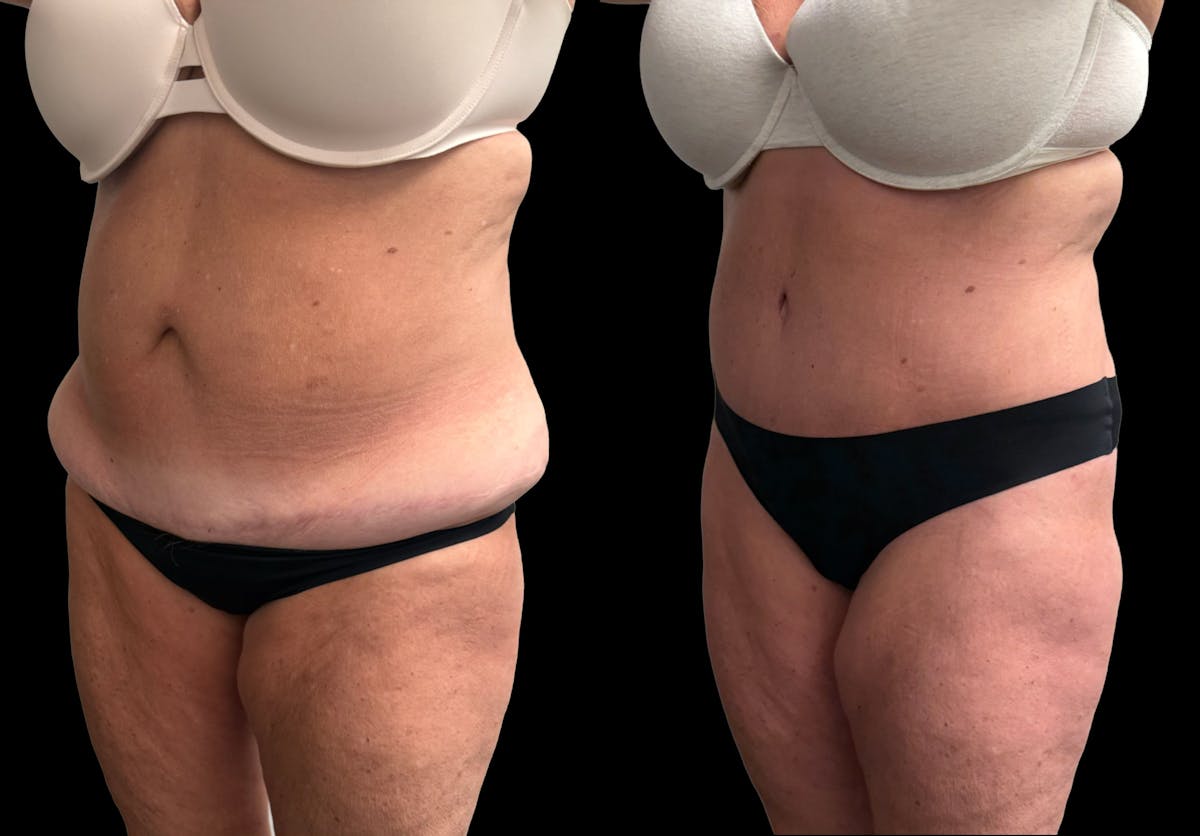 Tummy Tuck Before & After Gallery - Patient 342522 - Image 3