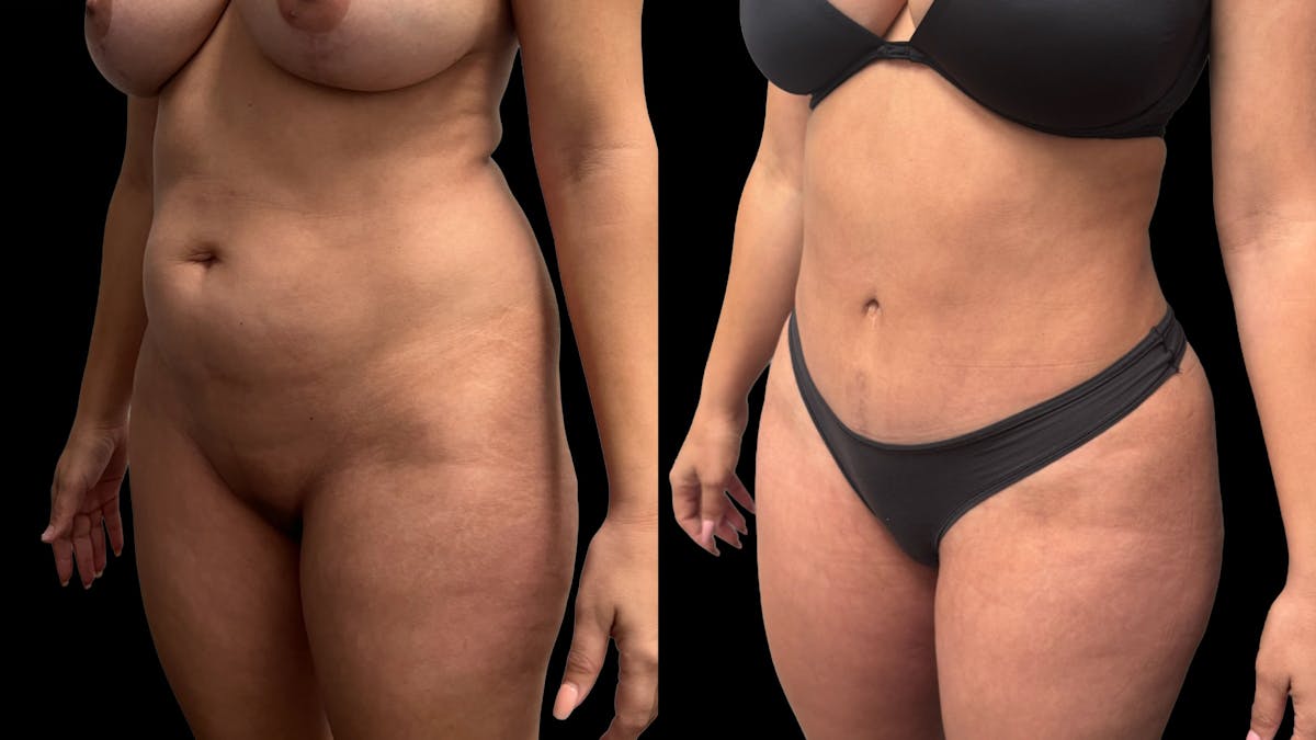 Tummy Tuck Before & After Gallery - Patient 359511 - Image 4