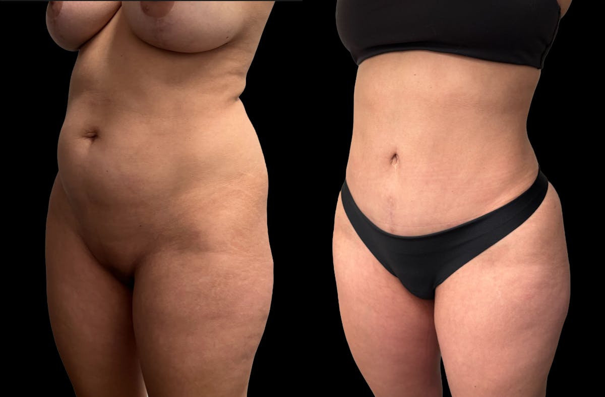 Tummy Tuck Before & After Gallery - Patient 359511 - Image 3
