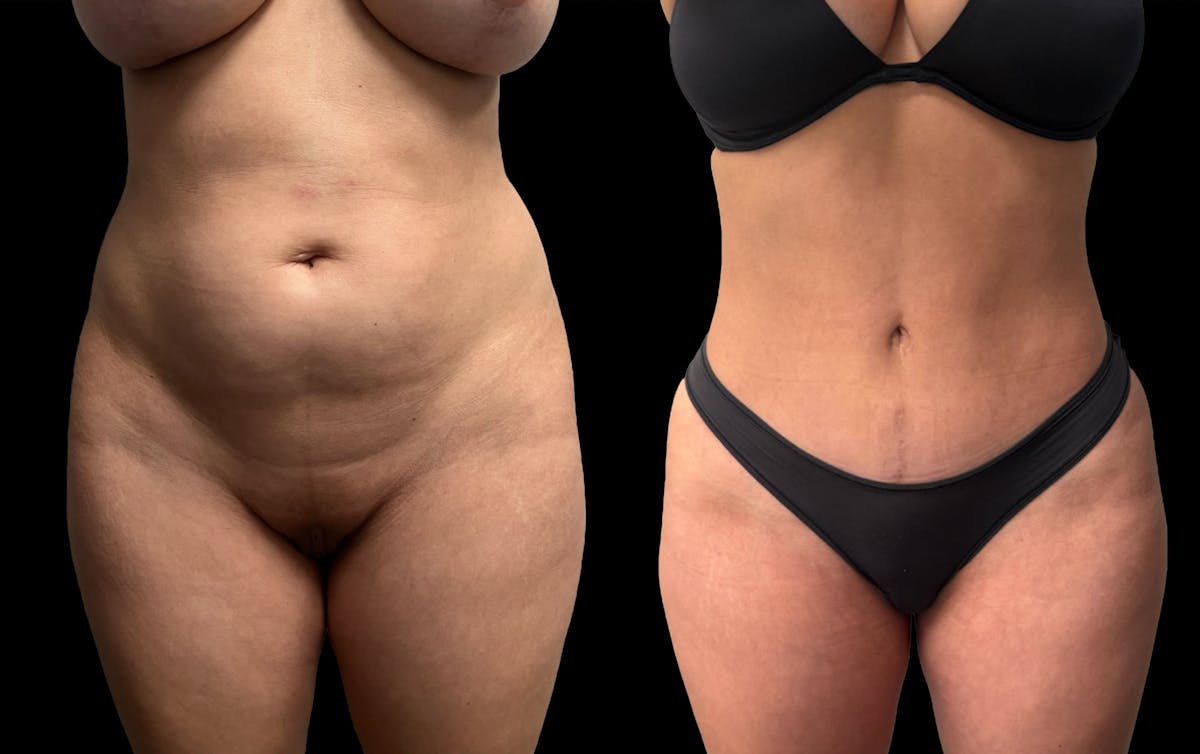 Tummy Tuck Before & After Gallery - Patient 359511 - Image 2