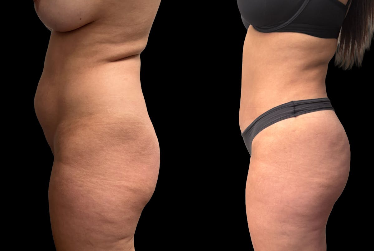 Tummy Tuck Before & After Gallery - Patient 359511 - Image 5