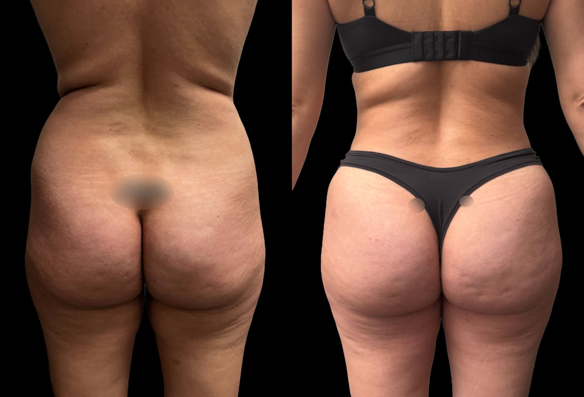Tummy Tuck Before & After Gallery - Patient 359511 - Image 6