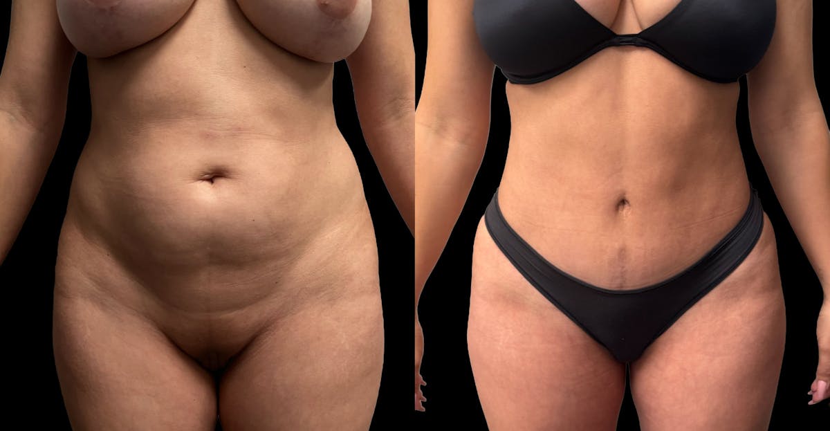 Tummy Tuck Before & After Gallery - Patient 359511 - Image 1