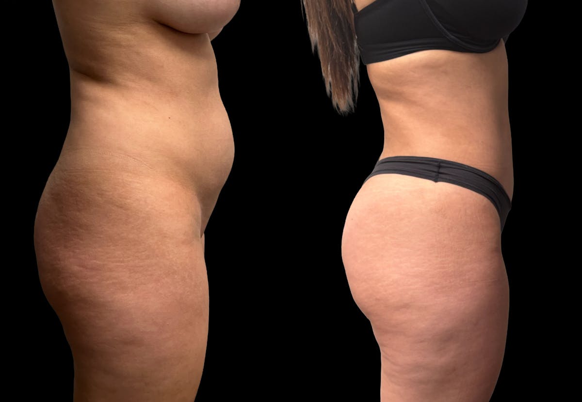 Tummy Tuck Before & After Gallery - Patient 359511 - Image 7
