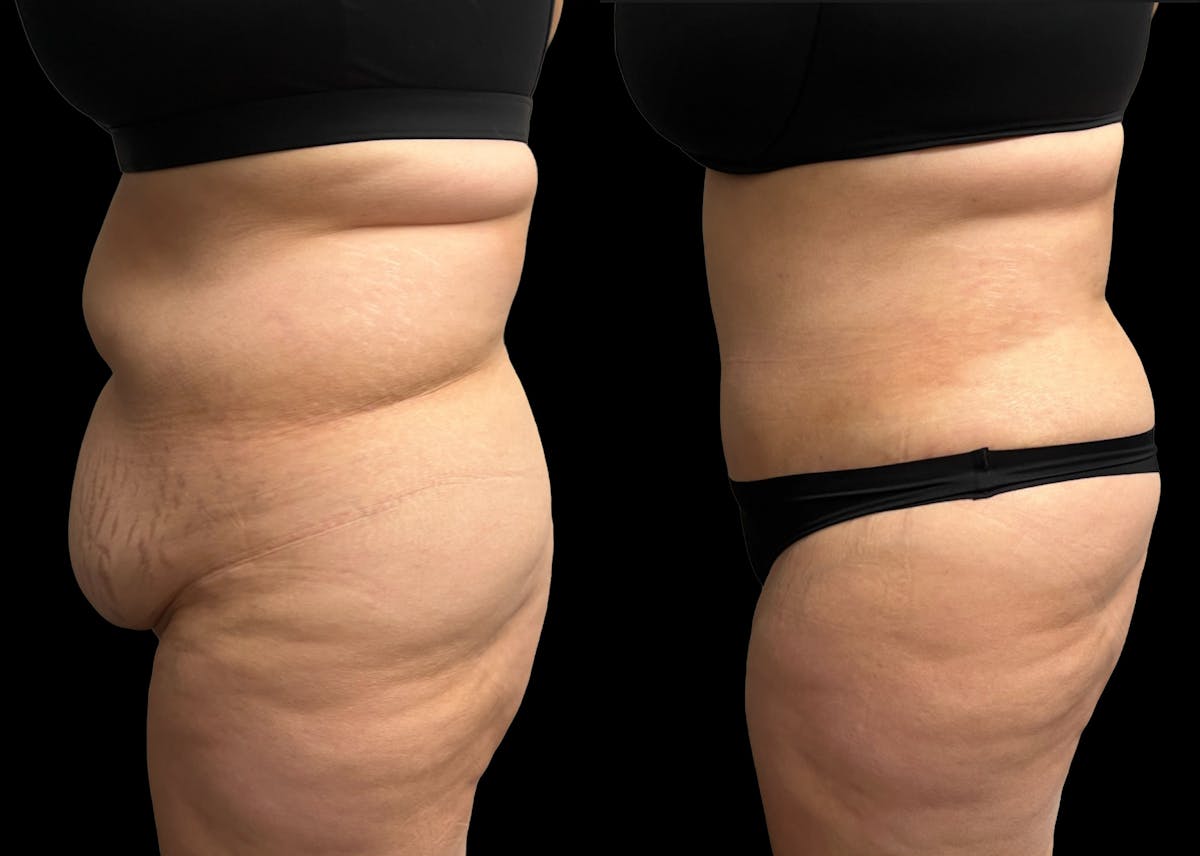 Tummy Tuck Before & After Gallery - Patient 379717 - Image 3