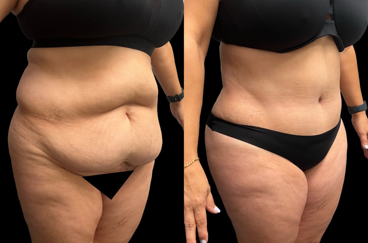 Tummy Tuck Before & After Gallery - Patient 379717 - Image 4