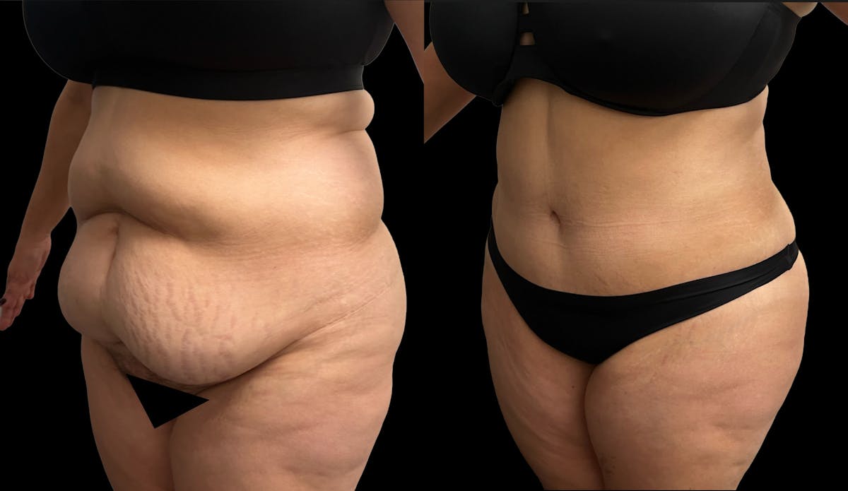 Tummy Tuck Before & After Gallery - Patient 379717 - Image 2