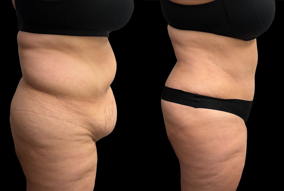 Tummy Tuck Before & After Gallery - Patient 379717 - Image 5