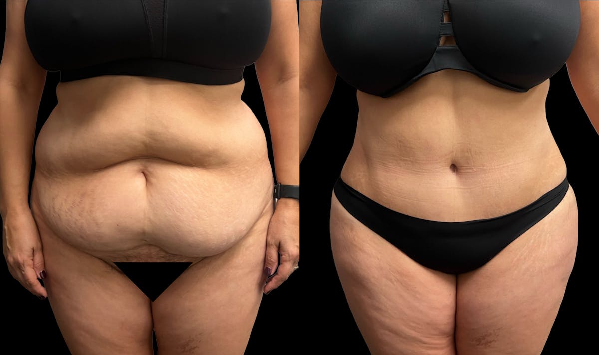 Tummy Tuck Before & After Gallery - Patient 379717 - Image 1