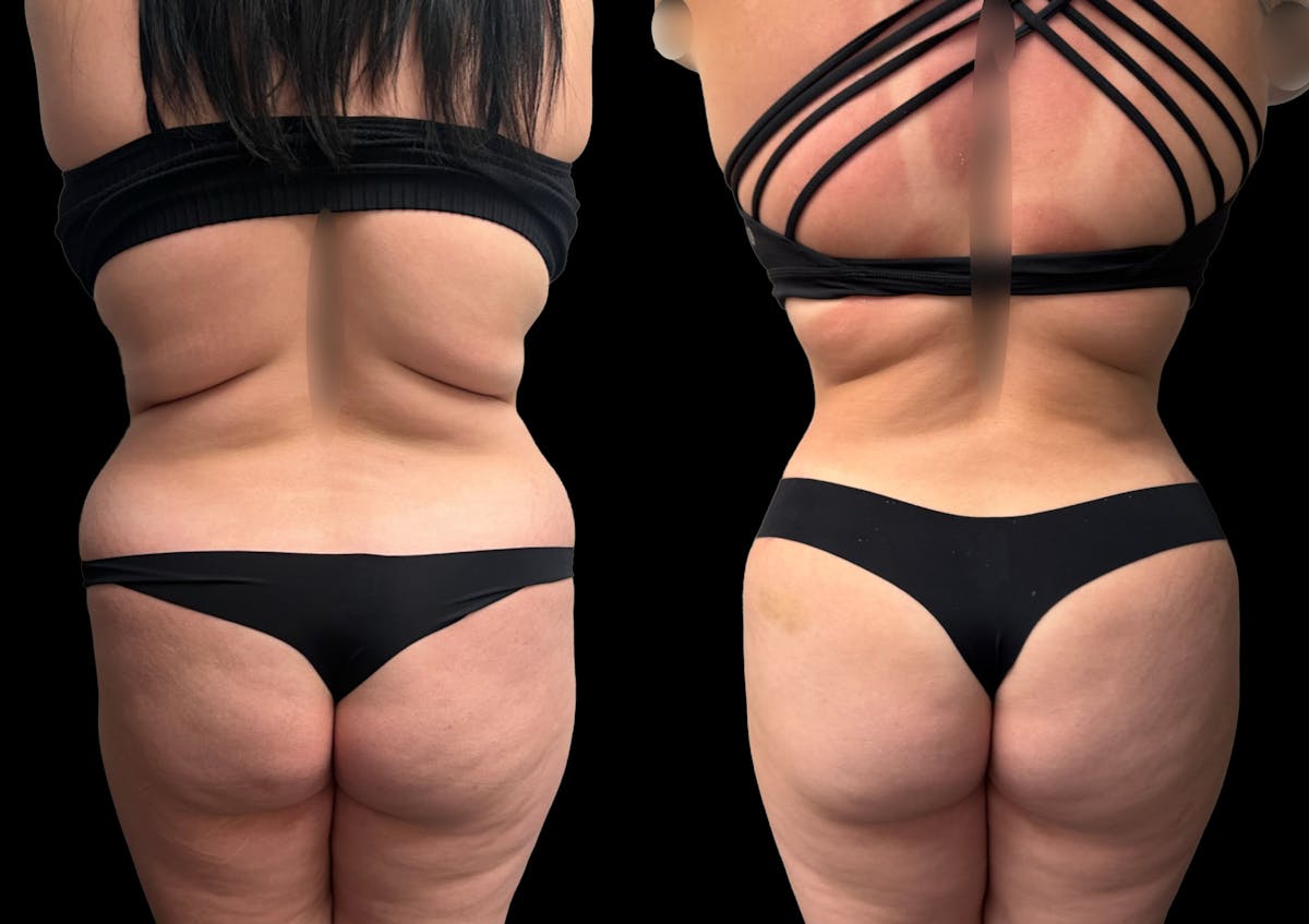 Tummy Tuck Before & After Gallery - Patient 354510 - Image 3