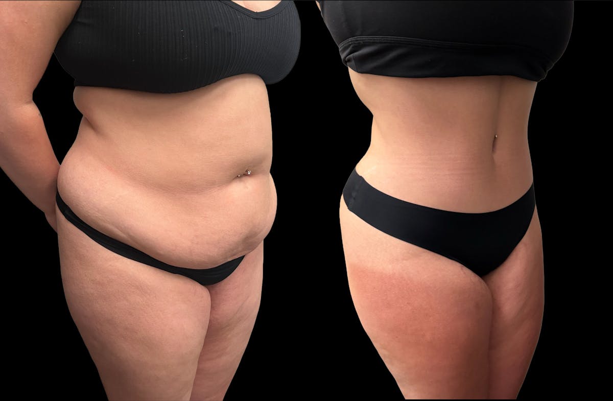 Tummy Tuck Before & After Gallery - Patient 354510 - Image 4