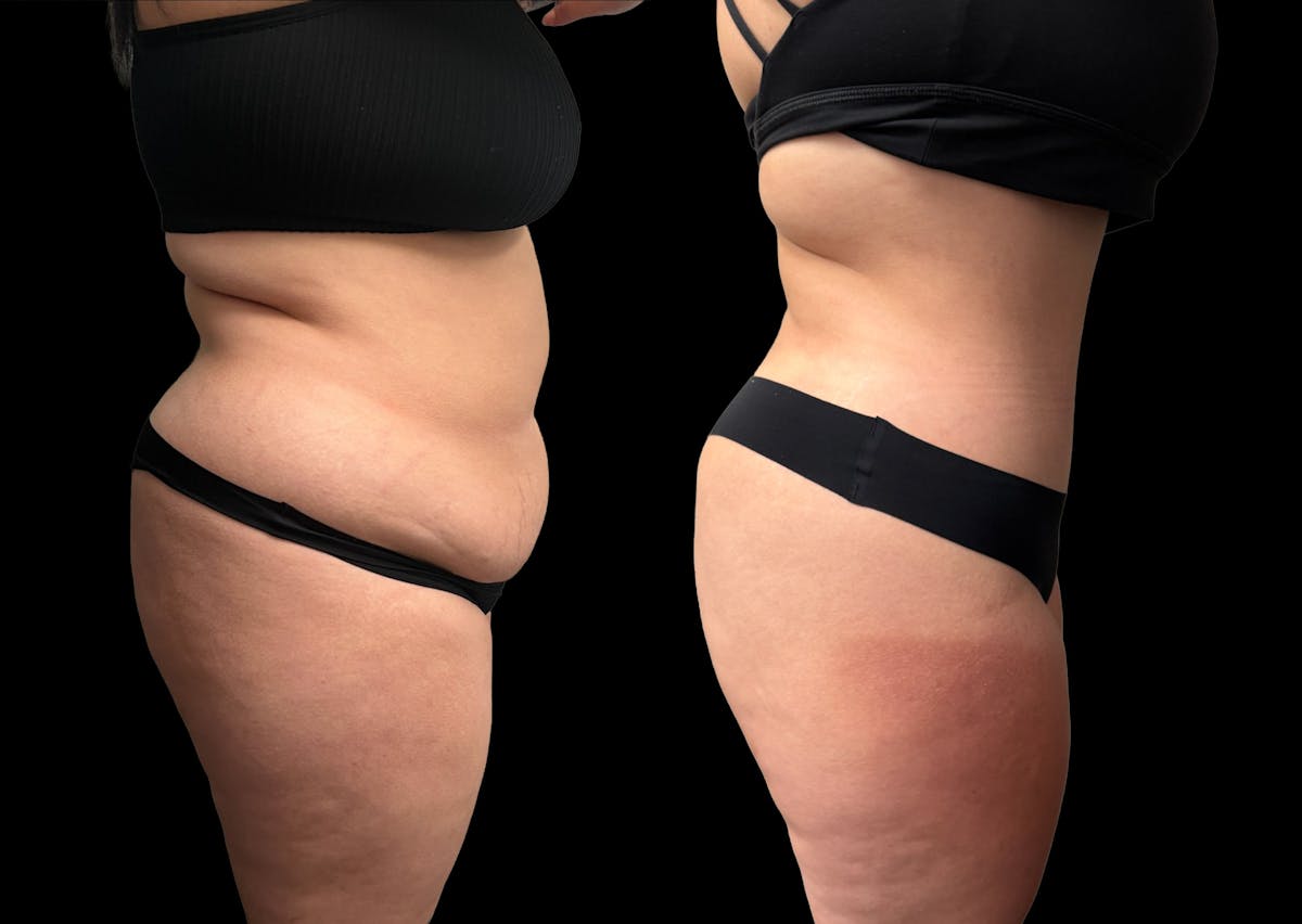 Tummy Tuck Before & After Gallery - Patient 354510 - Image 5