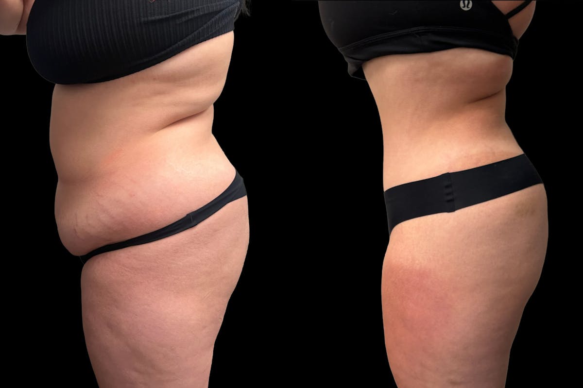 Tummy Tuck Before & After Gallery - Patient 354510 - Image 2