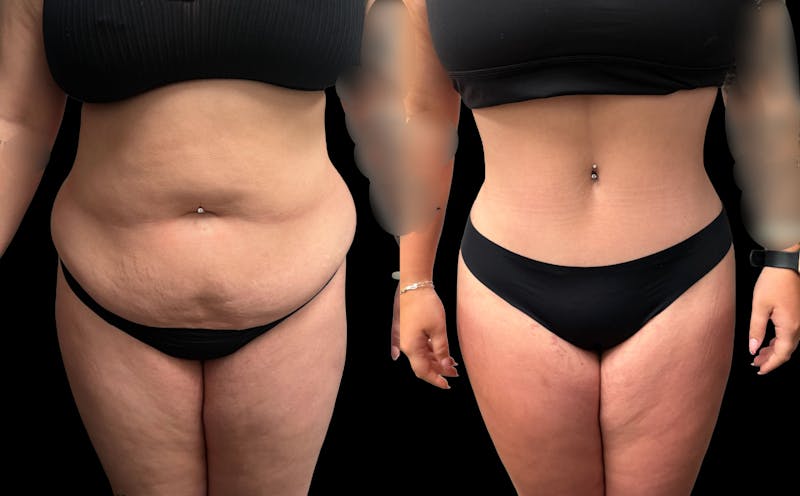 Tummy Tuck Before & After Gallery - Patient 354510 - Image 1