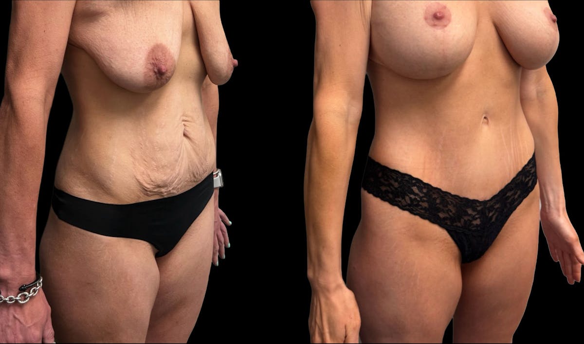 Tummy Tuck Before & After Gallery - Patient 411341 - Image 5