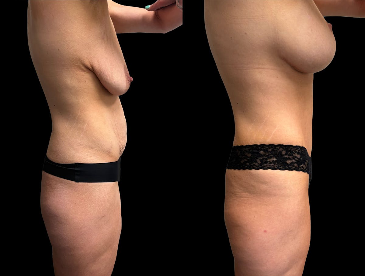 Tummy Tuck Before & After Gallery - Patient 411341 - Image 6