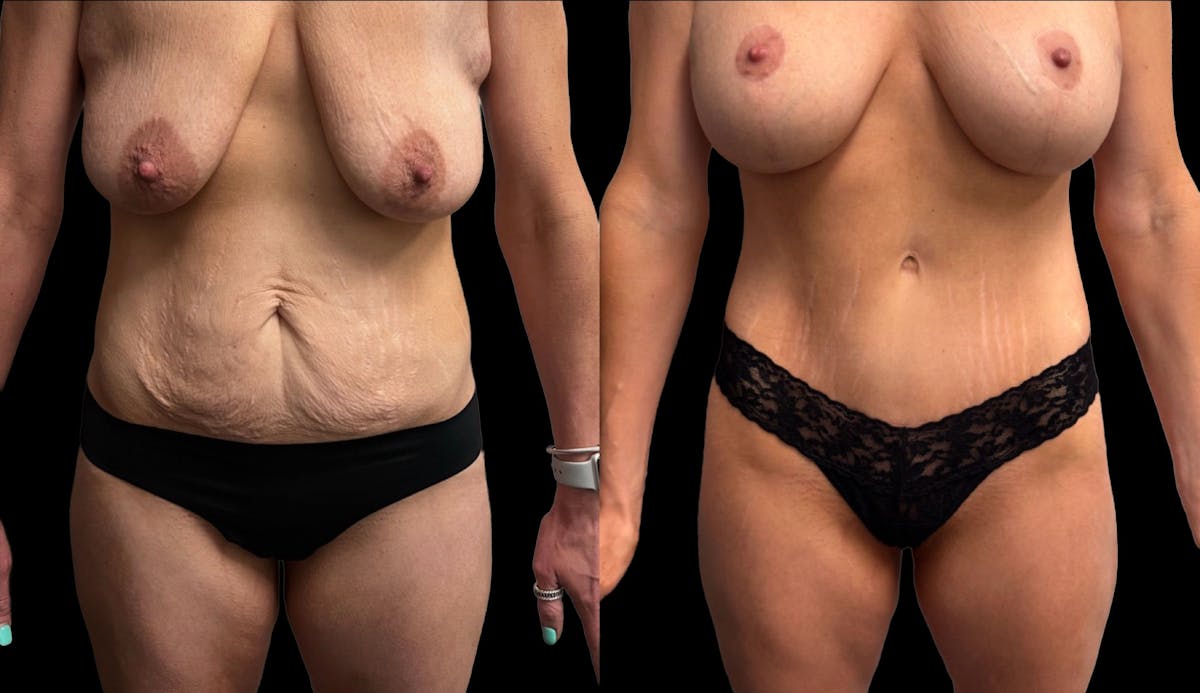 Tummy Tuck Before & After Gallery - Patient 411341 - Image 1