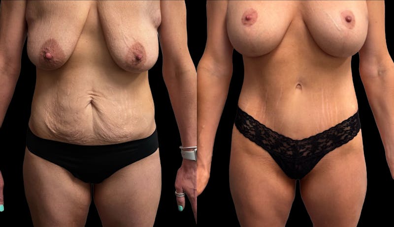 Tummy Tuck Before & After Gallery - Patient 411341 - Image 1