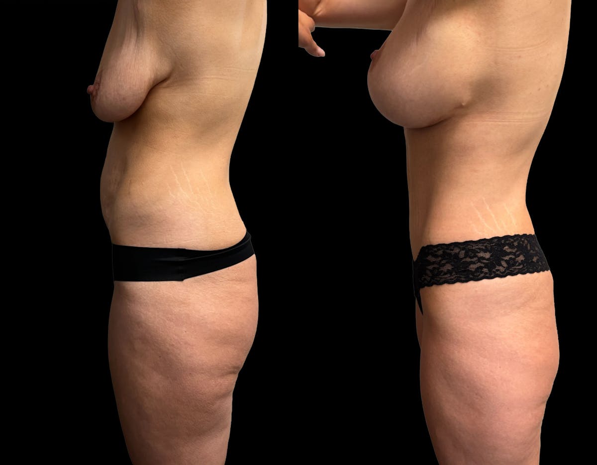 Tummy Tuck Before & After Gallery - Patient 411341 - Image 4