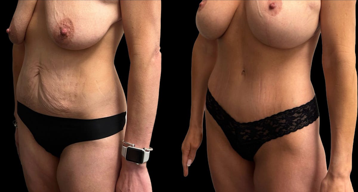 Tummy Tuck Before & After Gallery - Patient 411341 - Image 2