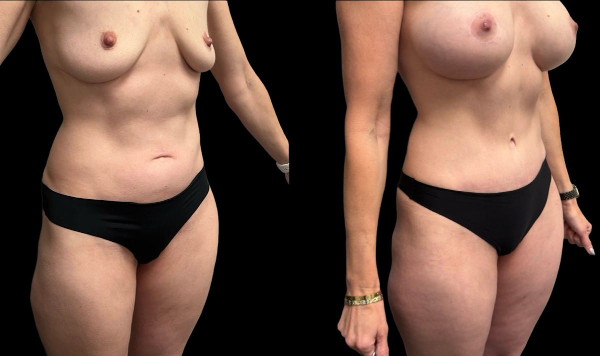 Tummy Tuck Before & After Gallery - Patient 114880 - Image 5