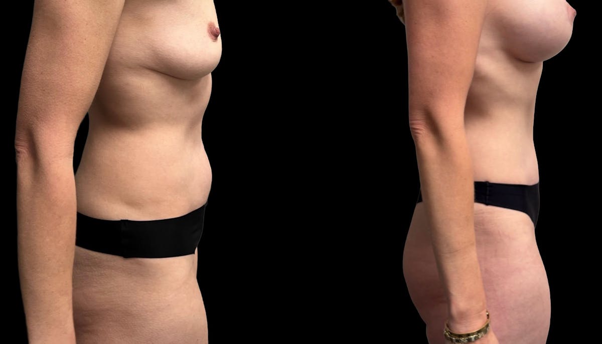 Tummy Tuck Before & After Gallery - Patient 114880 - Image 6