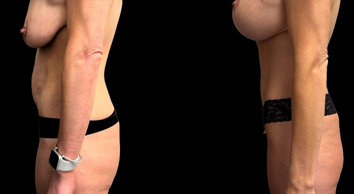 Tummy Tuck Before & After Gallery - Patient 114880 - Image 4