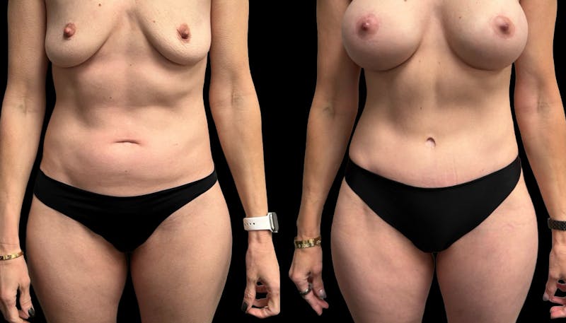 Tummy Tuck Before & After Gallery - Patient 114880 - Image 1