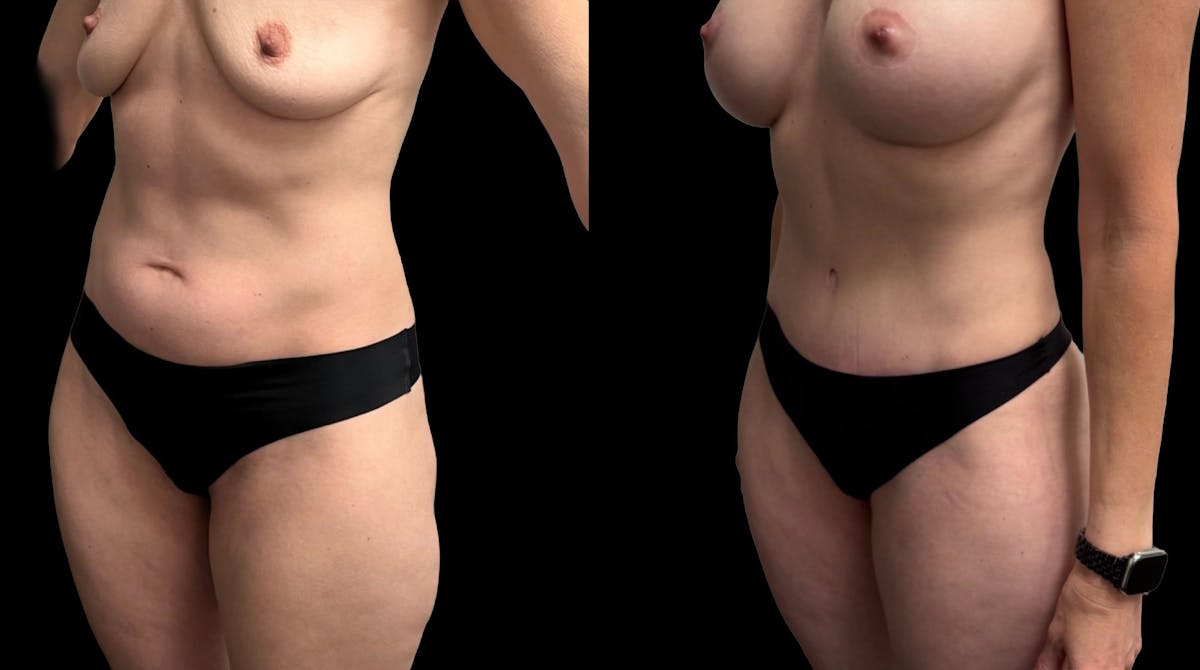 Tummy Tuck Before & After Gallery - Patient 114880 - Image 2
