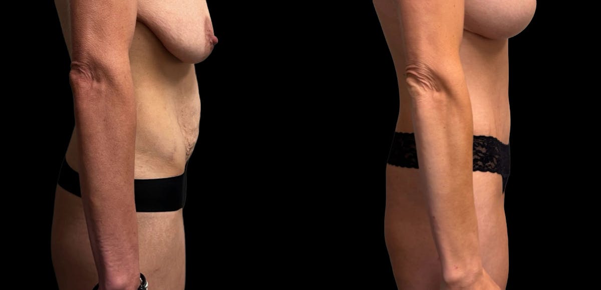 Tummy Tuck Before & After Gallery - Patient 114880 - Image 7