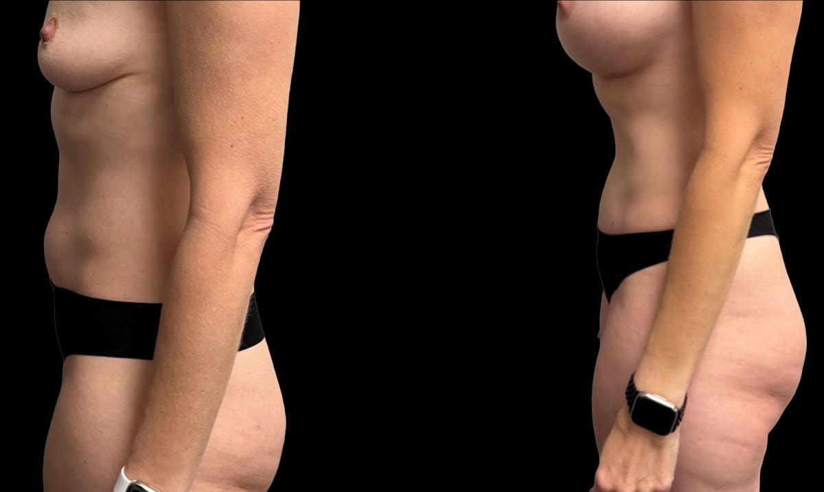 Tummy Tuck Before & After Gallery - Patient 114880 - Image 3
