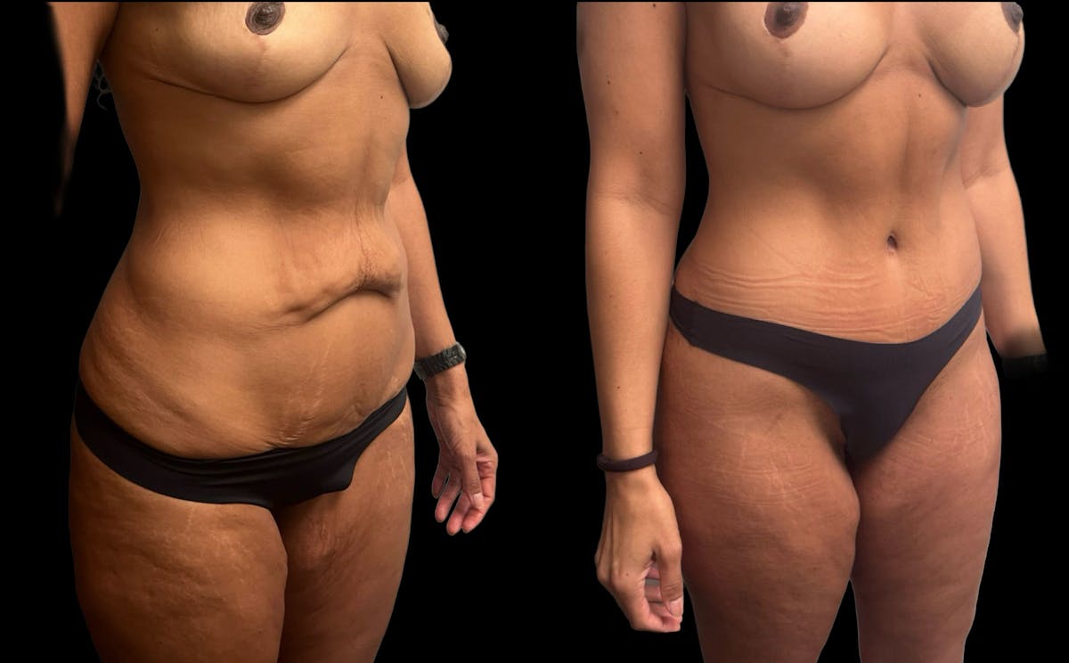 Tummy Tuck Before & After Gallery - Patient 210367 - Image 4