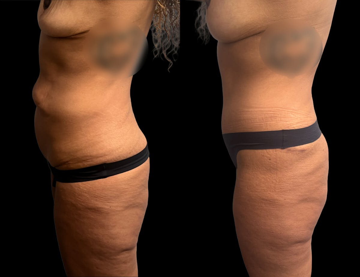Tummy Tuck Before & After Gallery - Patient 210367 - Image 3
