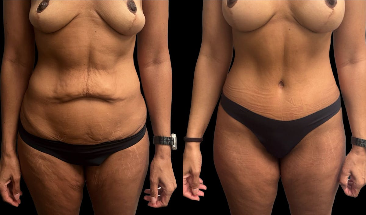 Tummy Tuck Before & After Gallery - Patient 210367 - Image 1