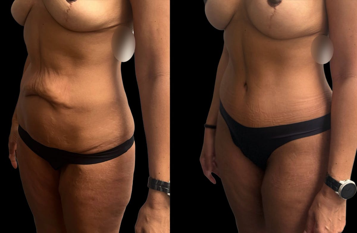 Tummy Tuck Before & After Gallery - Patient 210367 - Image 2
