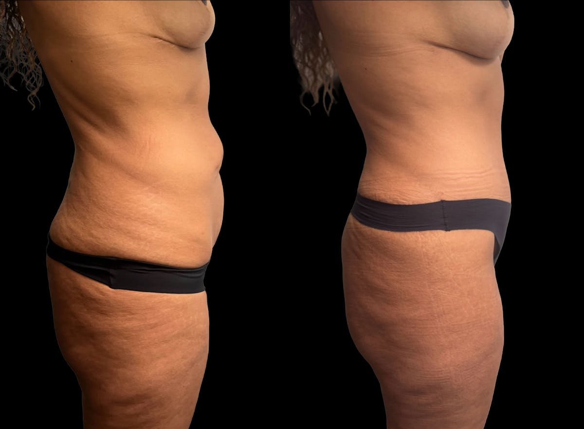 Tummy Tuck Before & After Gallery - Patient 210367 - Image 5