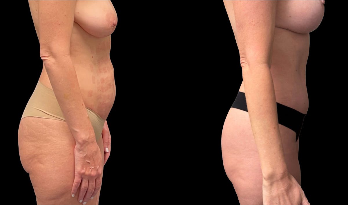Tummy Tuck Before & After Gallery - Patient 325213 - Image 5