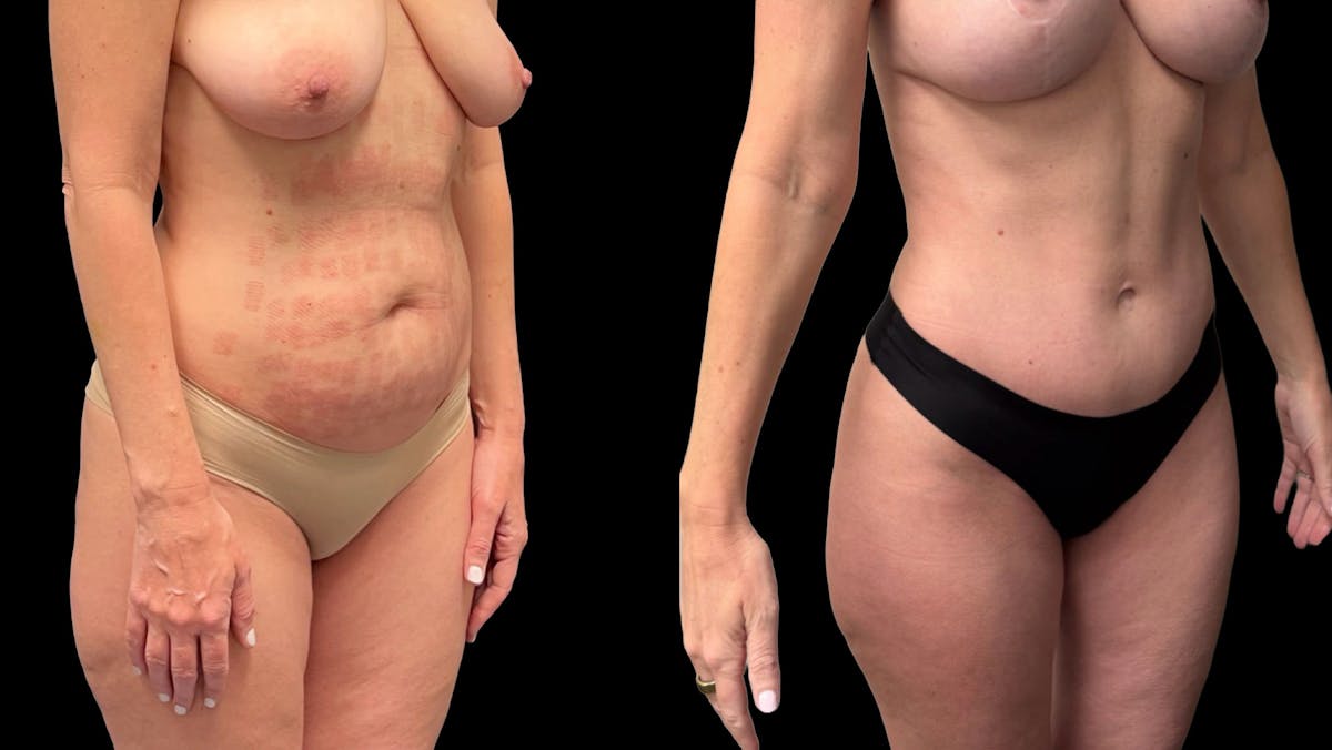 Tummy Tuck Before & After Gallery - Patient 325213 - Image 4