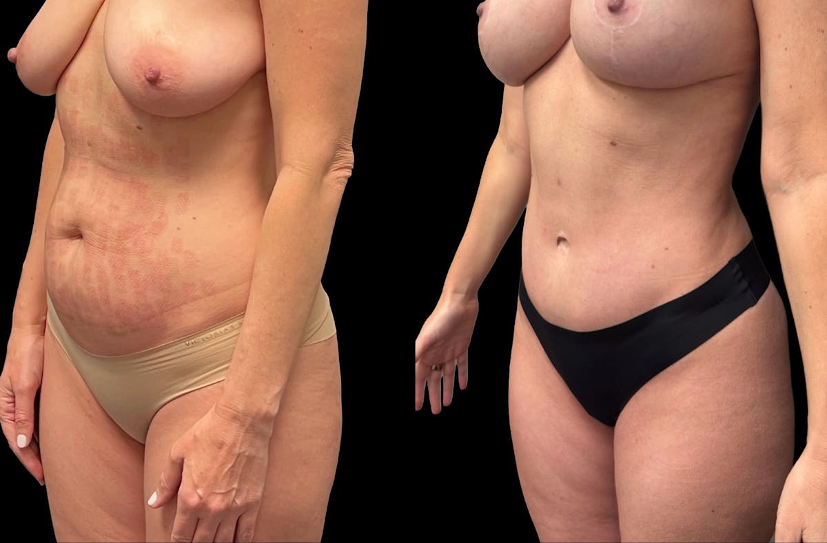Tummy Tuck Before & After Gallery - Patient 325213 - Image 2