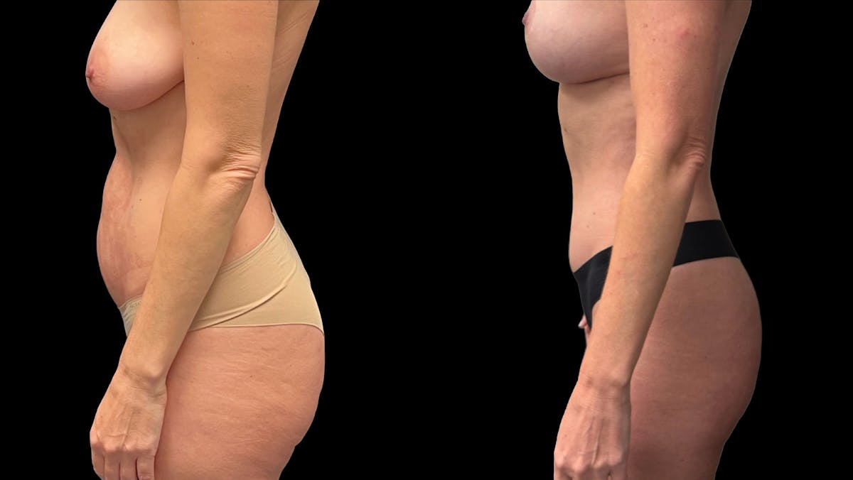 Tummy Tuck Before & After Gallery - Patient 325213 - Image 3