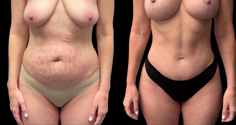 Tummy Tuck Before & After Gallery - Patient 325213 - Image 1
