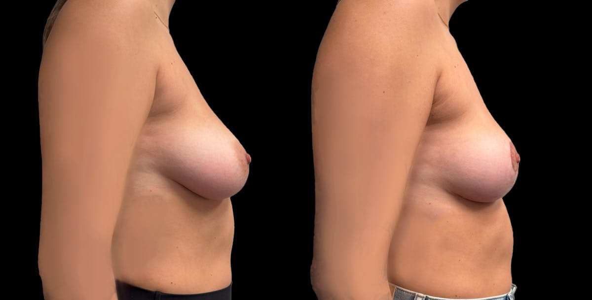 Breast Reduction Before & After Gallery - Patient 108627 - Image 3