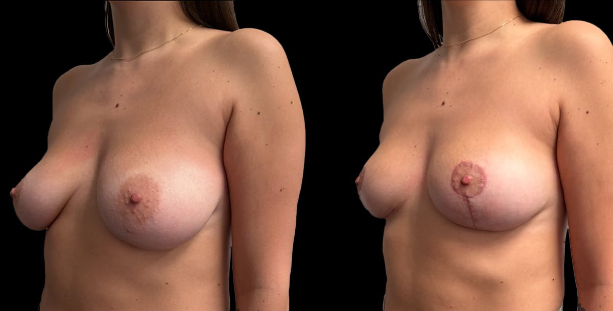 Breast Reduction Before & After Gallery - Patient 108627 - Image 4