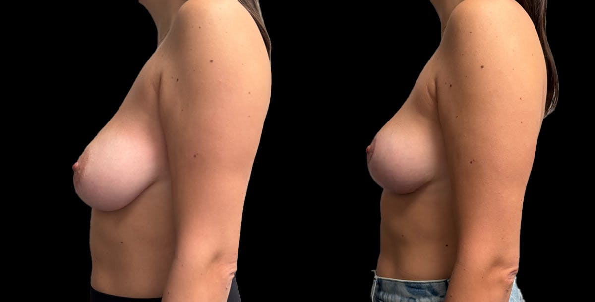 Breast Reduction Before & After Gallery - Patient 108627 - Image 5